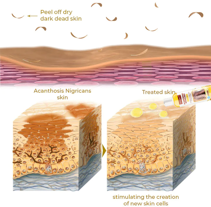 GFOUK Acanthosis Nigricans Peeling Oil