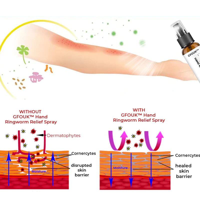 GFOUK Hand Ringworm Relief Spray