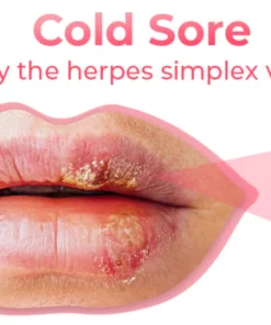 GFOUK Cold Sores Therapy Oil