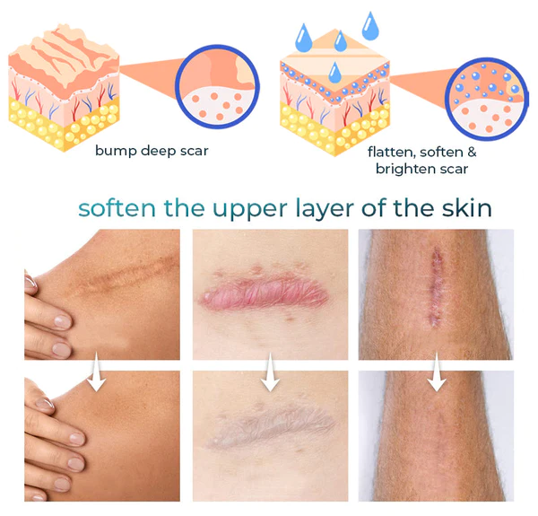 EpiClear Advanced Scar Removal Gel