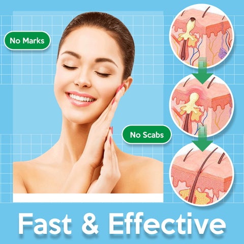 TagOff Skin Tag Remover