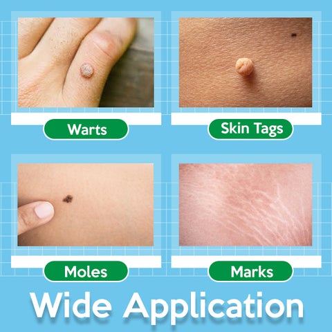 TagOff Skin Tag Remover