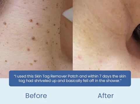 ClearDerm Skin Tag Removal Patch