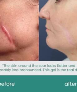 ScarXpert Advanced Scar Removal Gel