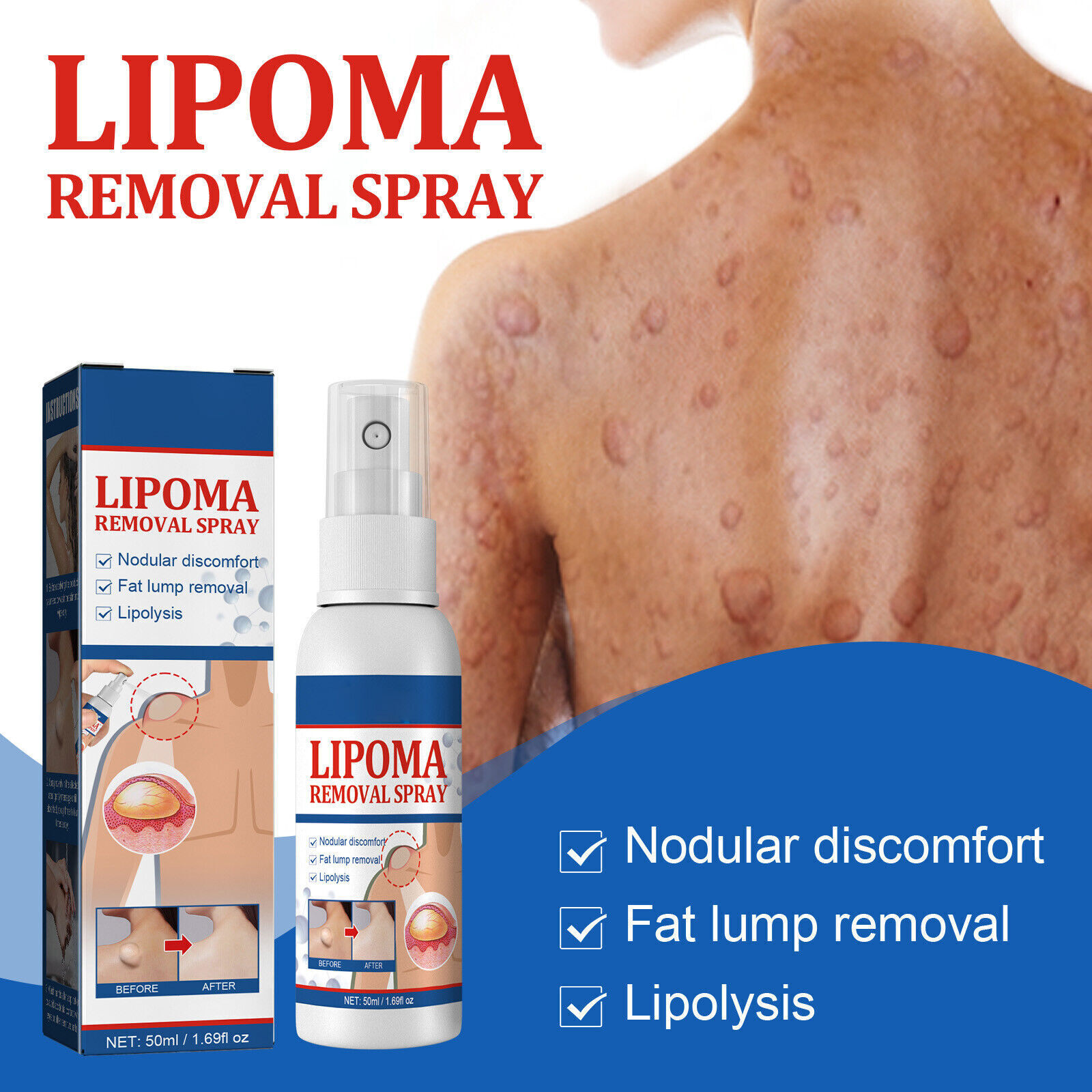 Herbal Lipoma Removal Spray