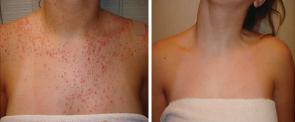 Dermax Folliculitis Clearing Spray