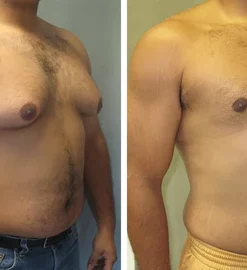 Sculptique Gynecomastia Cream