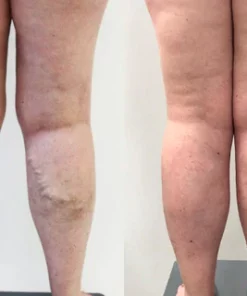 Veinhealing Varicose Veins Treatment Spray