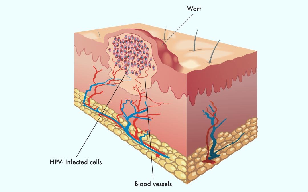 WartOff Instant Blemish Removal Cream