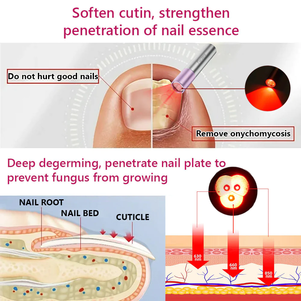 Furzero Nail Fungus Cleaning Laser Handheld Therapy Device
